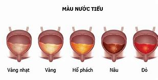 Nước Tiểu Có Màu Đỏ Nhạt Ở Nữ